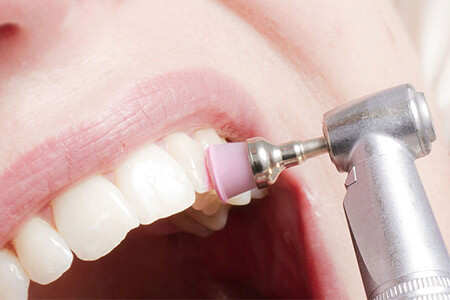 Saubere Zähne – was der Profi besser kann