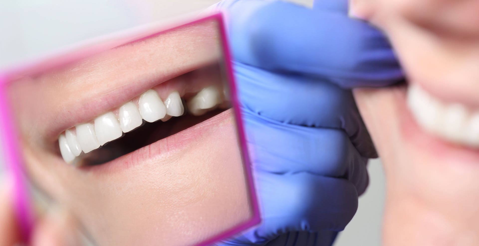 Deutscher Zahnversicherungs-Service Entscheidungshilfen Umgang von Zahnzusatzversicherungen mit fehlenden Zähnen